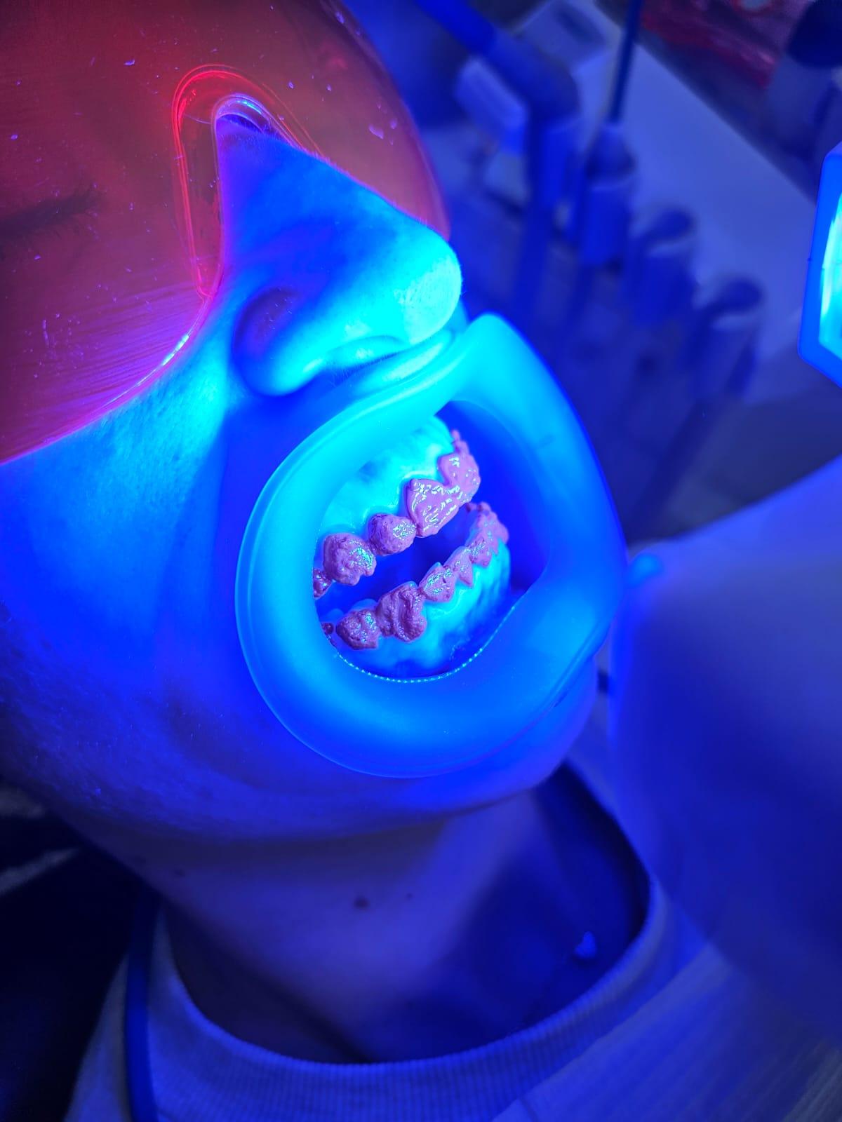 VisionButler durante uno sbiancamento dentale