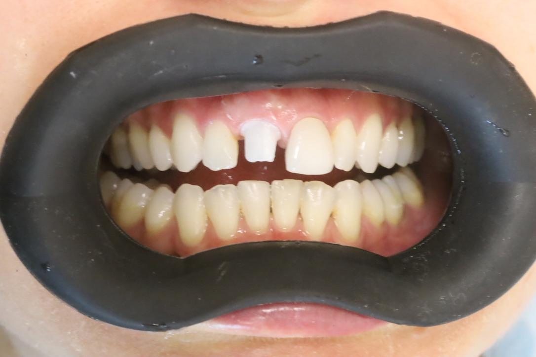 Fotografia odontoiatrica con VisionButler nero come contrastatore